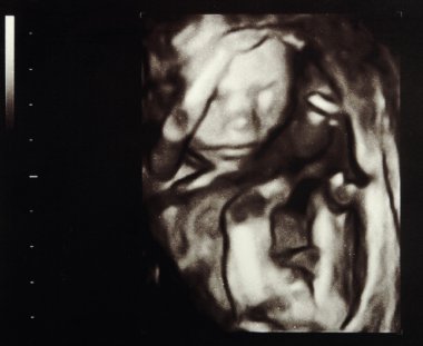 Ultrasound pregnancy clipart