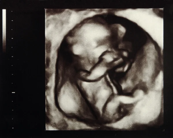 Embarazo por ultrasonido —  Fotos de Stock