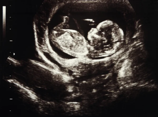 超音波妊娠 — ストック写真