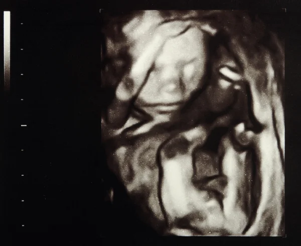 stock image Ultrasound pregnancy