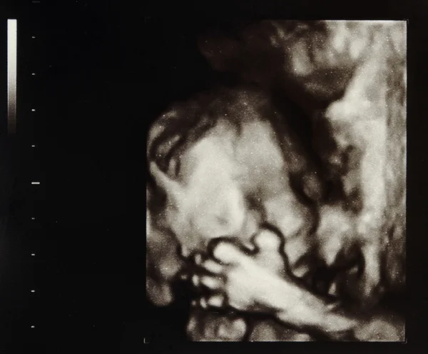 Ultrasound pregnancy — Stock Photo, Image