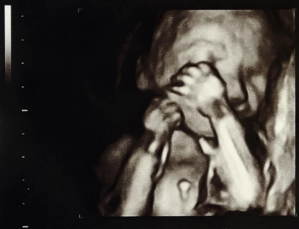 超声怀孕 — 图库照片