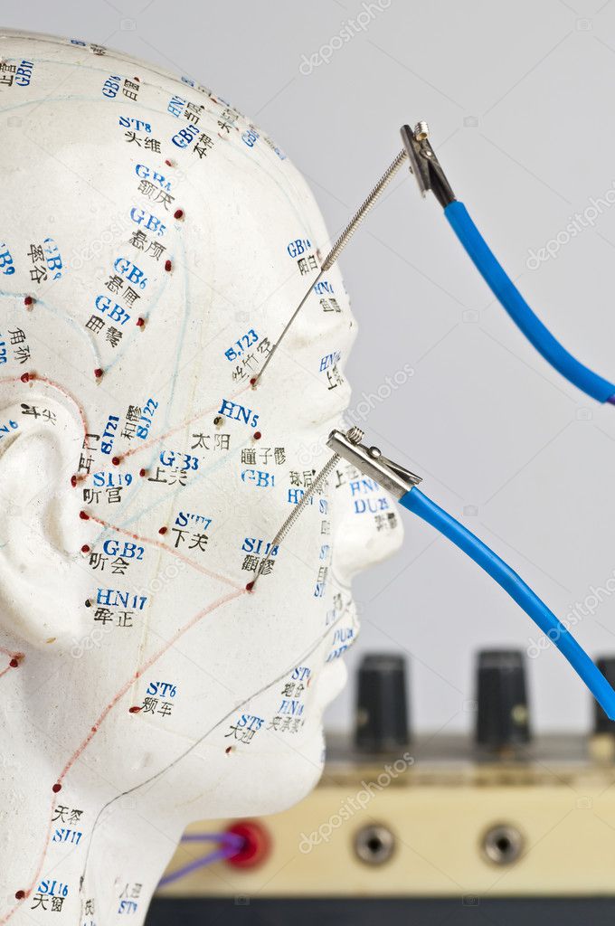 Electric-acupuncture
