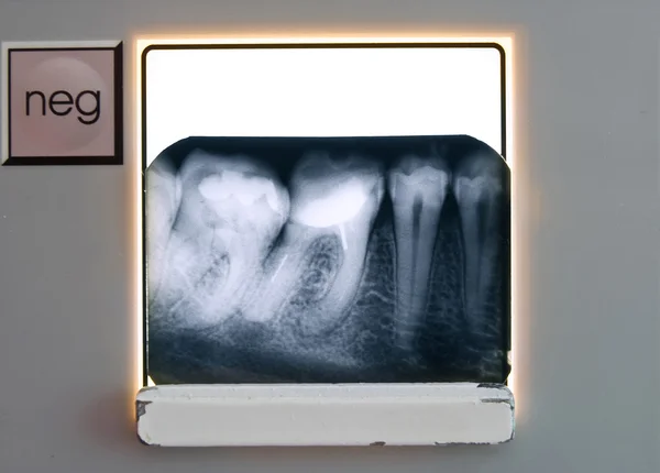 Holding Teeth Roentgenogram — Stock Photo, Image