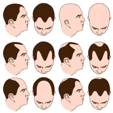 Receding Hairlines clipart
