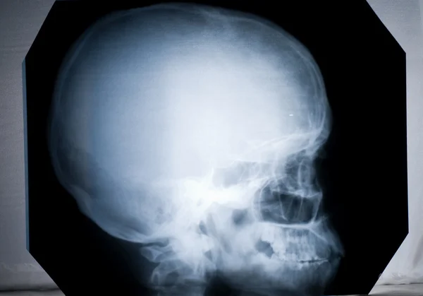 X-ray of a human head — Stock Photo, Image