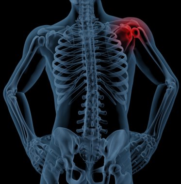 Shoulder pain clipart