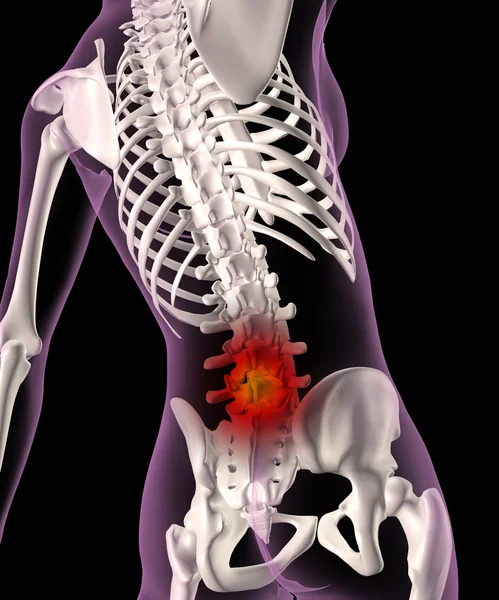 Bir dişi iskelet içinde sırt ağrısı — Stok fotoğraf