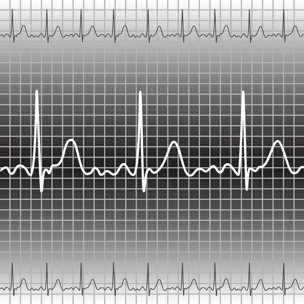 Elektrocardiogram — Stockvector