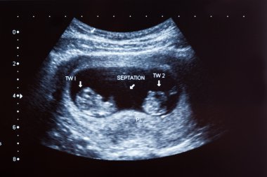 Ultrasound scan of 10 months old twins clipart