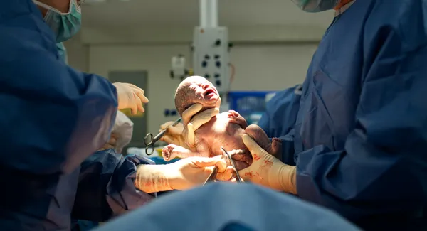 Bebê que nasce via cesariana — Fotografia de Stock