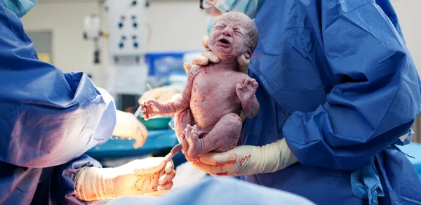 Baby wordt geboren via keizersnede — Stockfoto