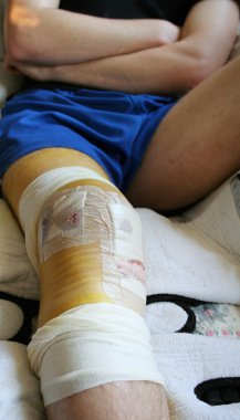 Injured leg and knee in bandages after operation. bloody limb in hospital cast clipart