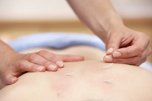 Traktowanie Klienta Kobiece Akupunktury — Zdjęcie stockowe