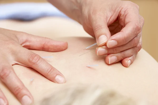 Traktowanie Klienta Kobiece Akupunktury — Zdjęcie stockowe