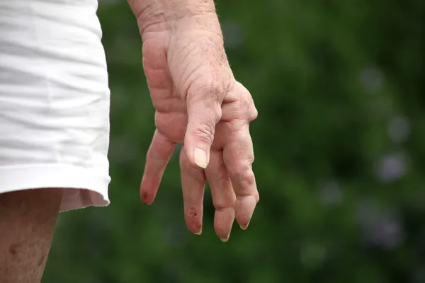 Mão Uma Mulher Idosa Com Artrite Reumatoide Mostrando Nódulos Sua Imagens De Bancos De Imagens