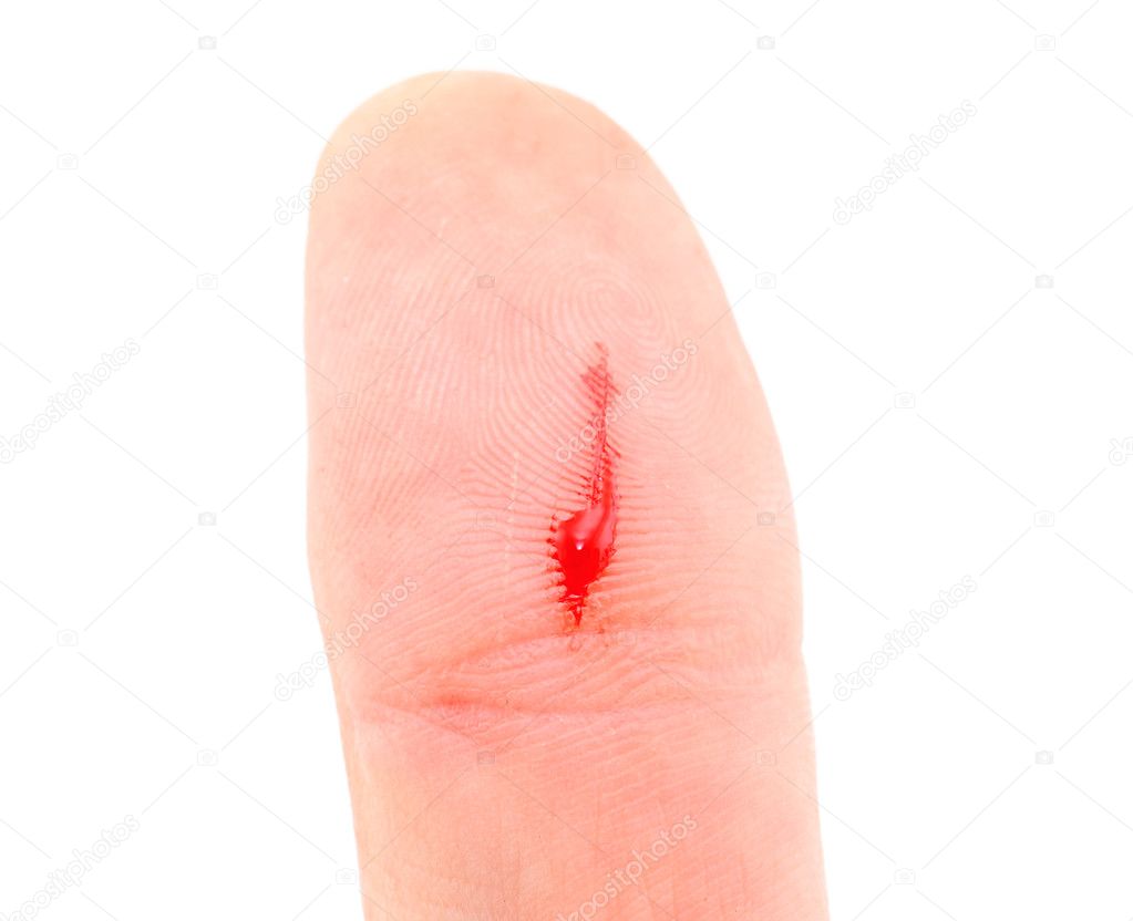 Bleeding thumb finger isolated on white