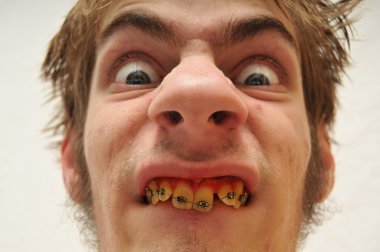 Hideous Monstrous Man staring at the camera with wide eyes, yellow crooked teeth with braces and huge nose. Eww! Ugly. clipart