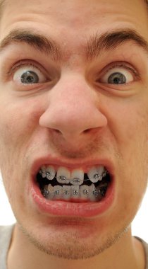 Young white causcasian man shows off his new braces on his pure white teeth. clipart