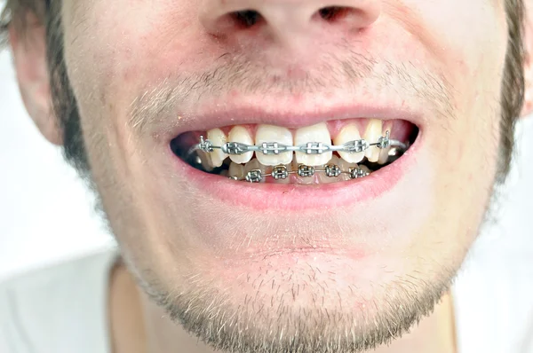 Aparat ortodontyczny — Zdjęcie stockowe