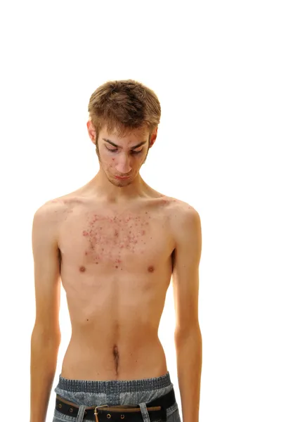 Ung Tonåring Ser Ner Hans Bröst Att Massa Acne — Stockfoto
