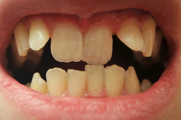 Gros Plan Des Dents Vraiment Tordues — Photo