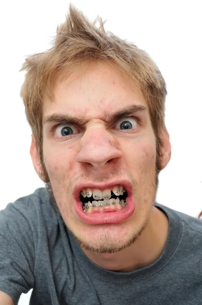 Man showing his braces — Stock Photo, Image