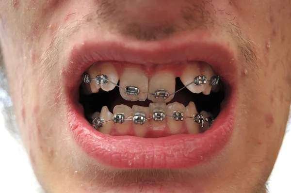 Bliska krzywe zęby z nawiasy klamrowe — Zdjęcie stockowe