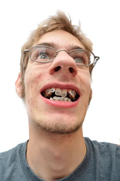 Man smiling showing his braces — Stock Photo, Image