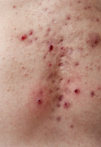 白人男性の胸に悪いにきびの発疹のクローズ アップのテクスチャ — ストック写真