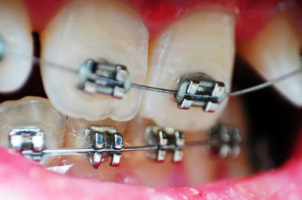 Questa Immagine Primo Piano Denti Storti Non Allineati Con Bretelle — Foto Stock