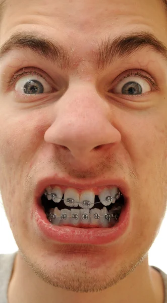 Jovem Homem Branco Causcasiano Mostra Seus Novos Aparelhos Seus Dentes — Fotografia de Stock