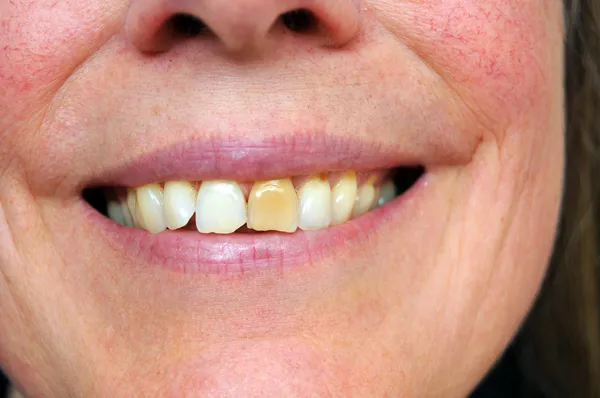 Person smiling with a stained yellow tooth right in front