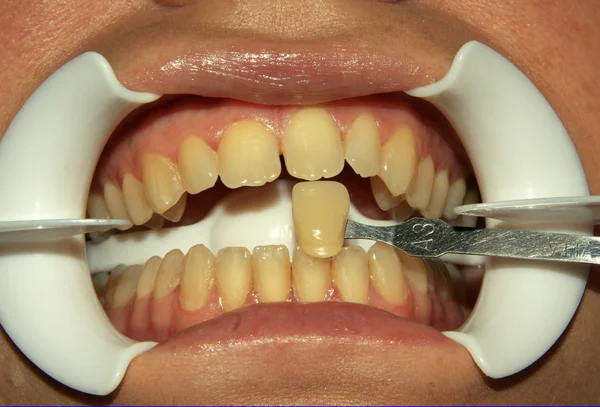 stock image Anterior teeth