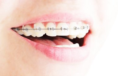 Teeth with braces clipart