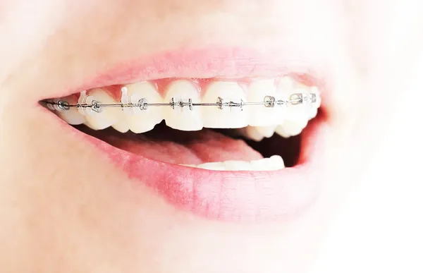 Zähne mit Zahnspange — Stockfoto