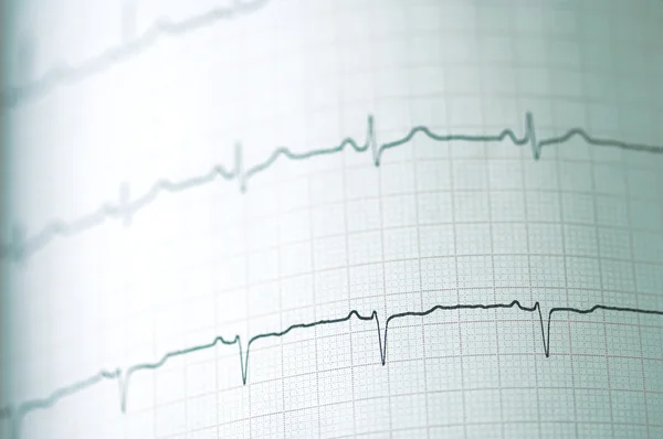 Elektrokardiogram — Stockfoto