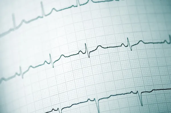 Elektrocardiogram — Stockfoto
